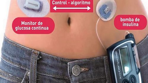 Prueban con éxito un páncreas artificial desarrollado en Argentina