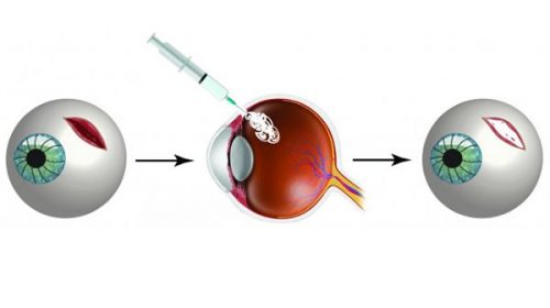 Crean un pegamento que permite curar heridas de los ojos antes de llegar a la operación