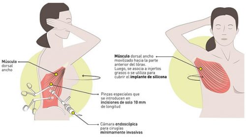 Por primera vez en el país, realizan reconstrucción mamaria mínimamente invasiva