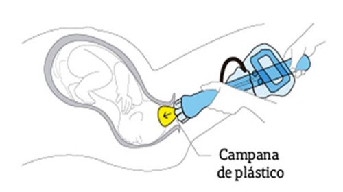 Un invento argentino busca entrar en la historia de la obstetricia