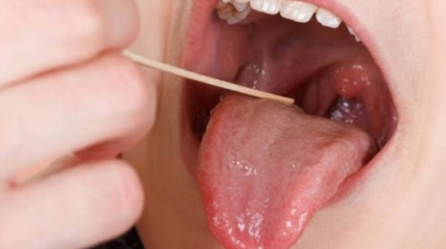 Ya suman diez las víctimas fatales por la bacteria del streptococcus pyogene