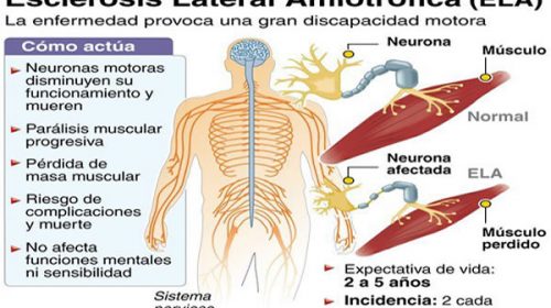 Hallazgo sobre la enfermedad ELA abre una vía a nuevos tratamientos