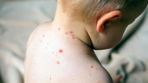 No hay casos de sarampión en la provincia, pero refuerzan la prevención en niños y adultos