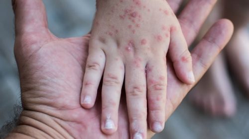 Brote de sarampión en todo el mundo: la OMS emite nueva alerta