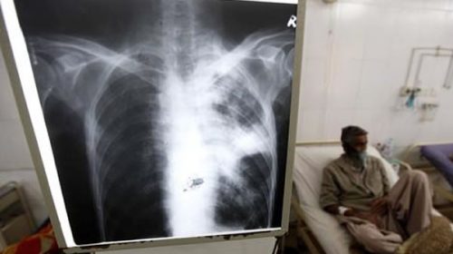 Argentinos desarrollaron un test rápido y de bajo costo para el diagnóstico de la tuberculosis