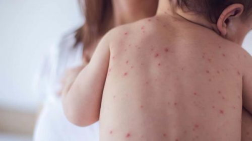 El Ministerio de Salud de Entre Ríos reafirma la importancia de la vacuna contra el sarampión